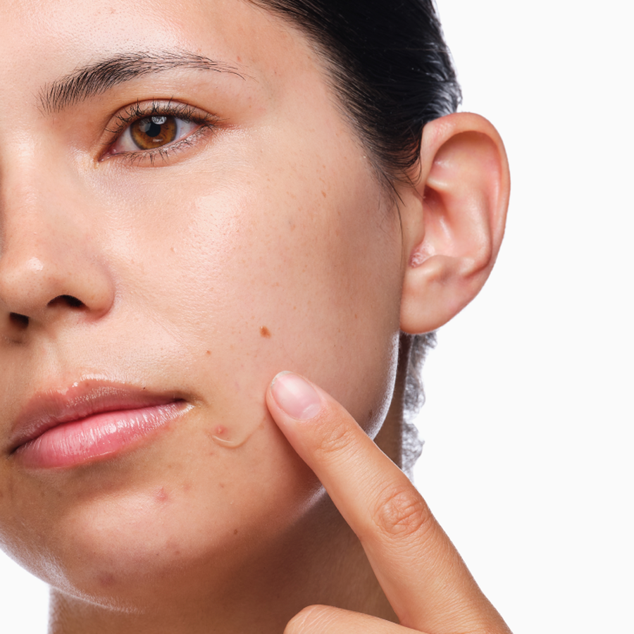 the-acne-set-t6 rdn-the-acne-set-application.png